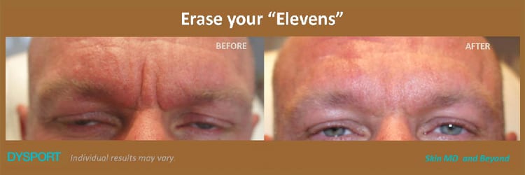 man's forehead before and after injectable frown line treatment