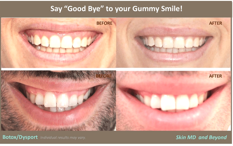 smile lip gummy mouth botox dysport results injections rejuvenation tx plano frisco natural skinmdandbeyond