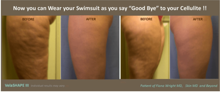 Body Contouring and Cellulite Reduction