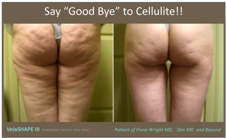 A before and after image of a woman that underwent cellulite treatment with VelaSHAPE III