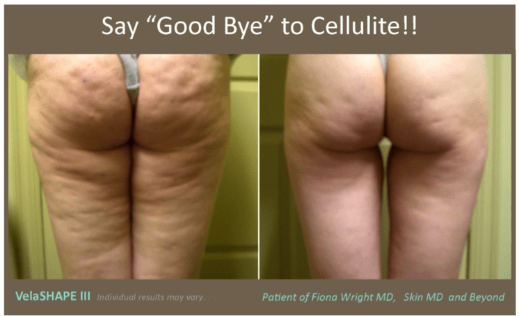 Cellulite Reduction VELASHAPE  Las Vegas Nevada, Bullhead City, Laughlin