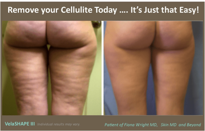 Cellulite Treatment Before-and-After Photos