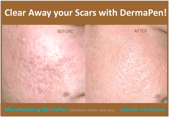 Scar Treatment in Plano, TX