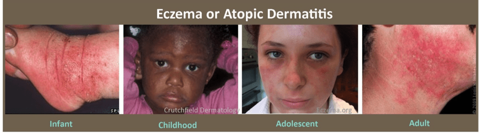 eczema