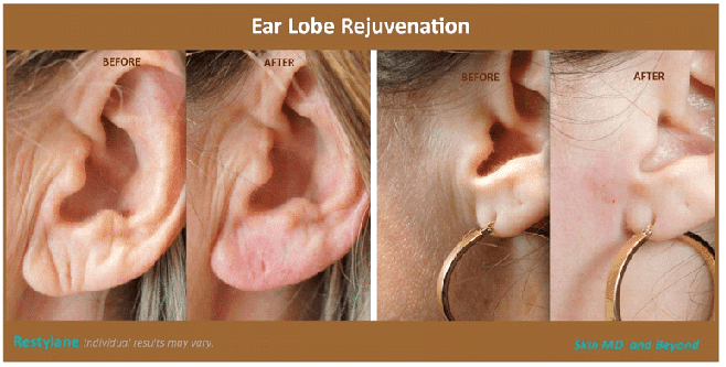 Ear Lobes 