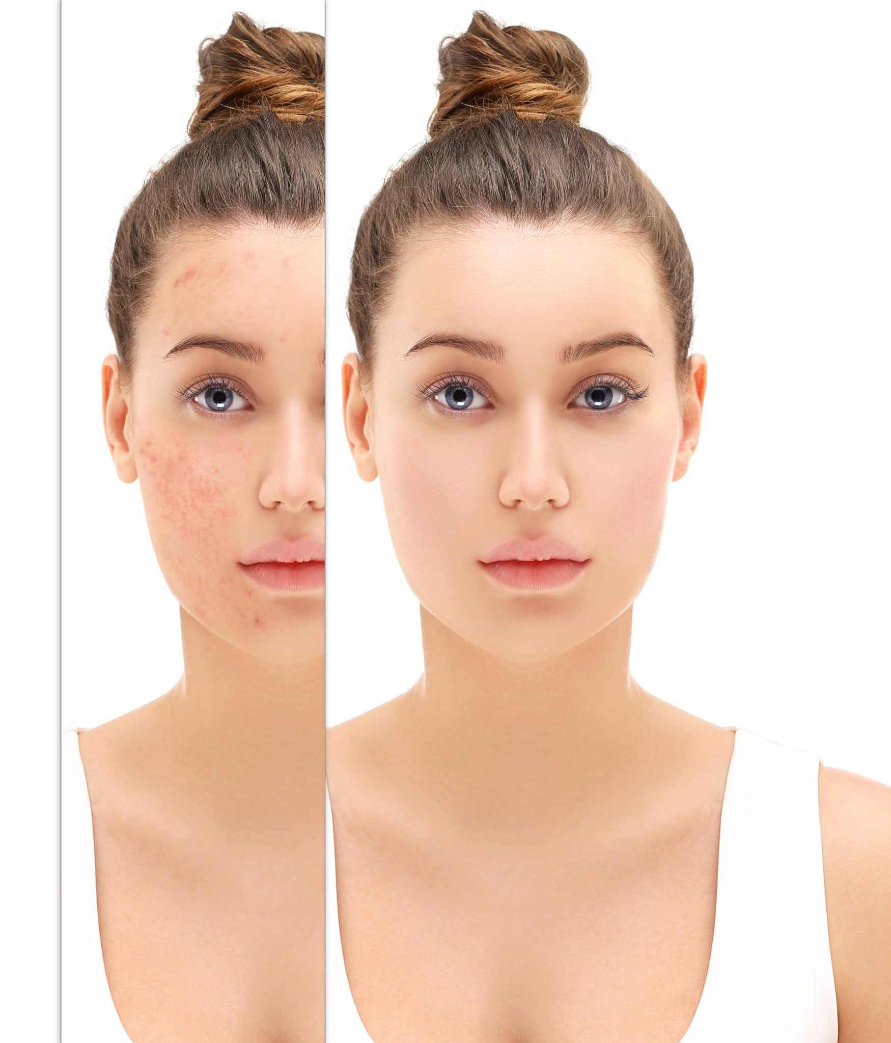 Chemical Peel Plano, TX | Expert Dermatologist in Frisco, TX