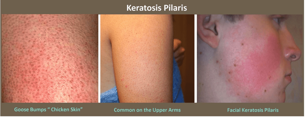 keratosis pilaris treatment before and after