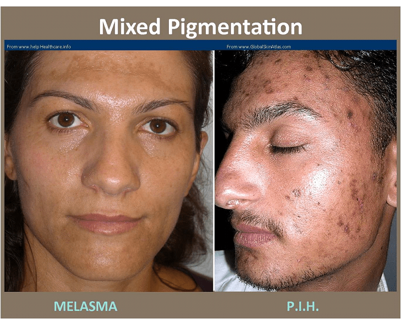 melasma