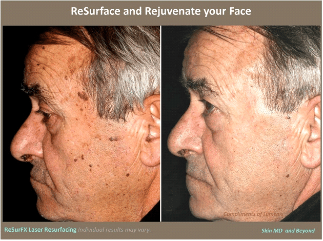 Facial store laser resurfacing