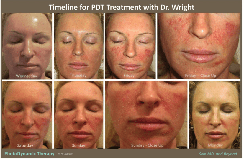 Photodynamic Therapy Plano, TX PDT Frisco, TX Acne Treatment