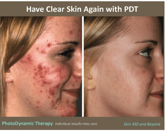 photodynamic therapy acne cost