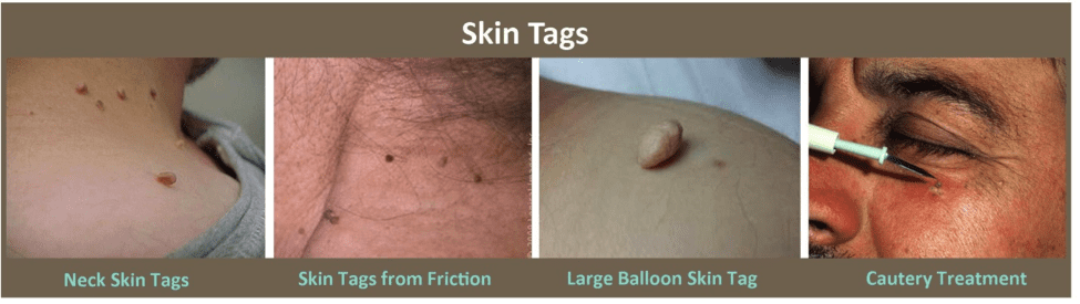 skin tags on neck removal