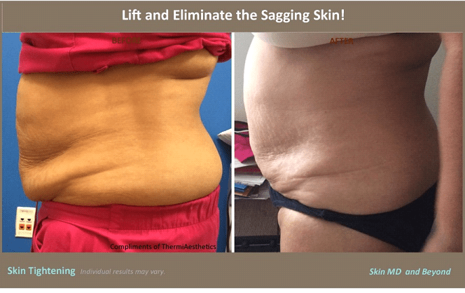 Skin Tightening Treatment Plano, TX