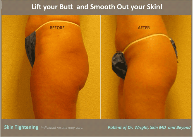 How to Tighten Loose or Saggy Skin on Thighs