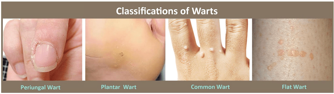 warts