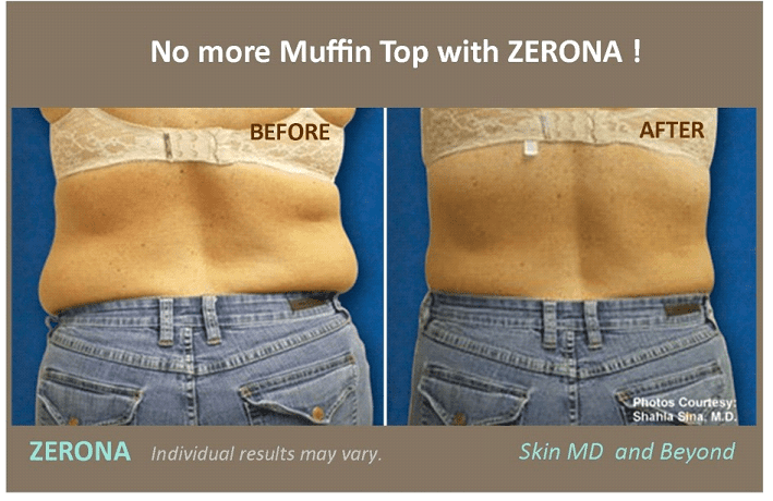 Zerona Plano TX | Fat Removal Frisco TX | Body Contouring