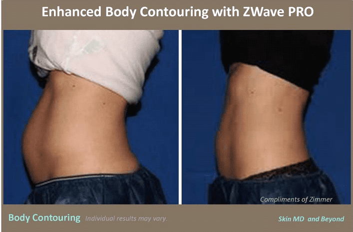 Cellulite Removal Plano TX, Body Contouring Frisco TX